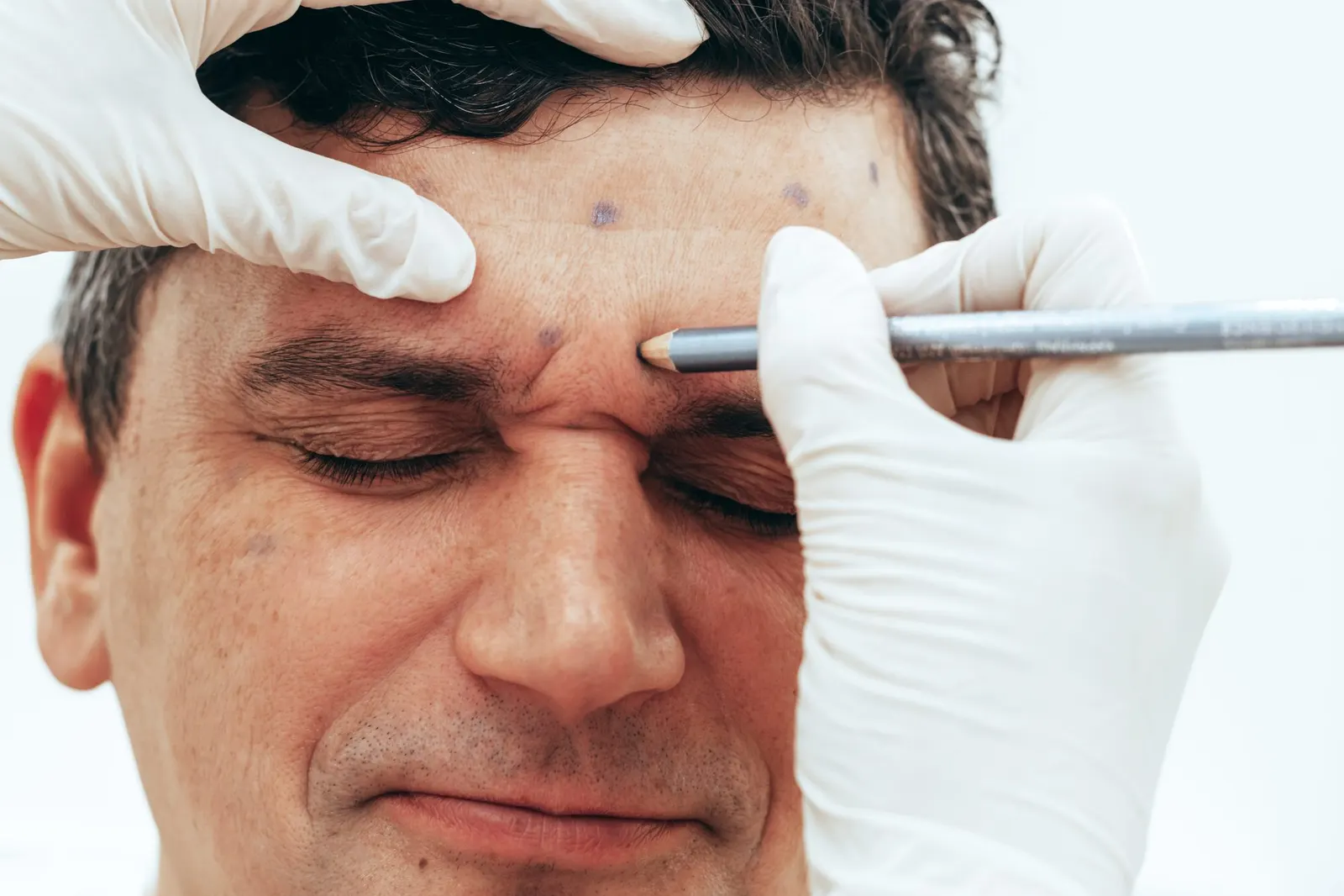 Profissional com luvas a marcar os pontos na testa com lápis