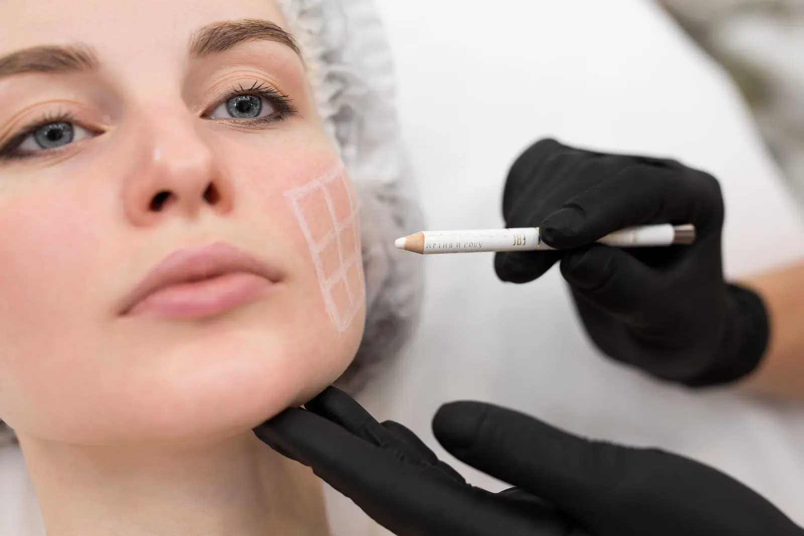 Gloved practitioner drawing the plan on the cheek with a white pencil
