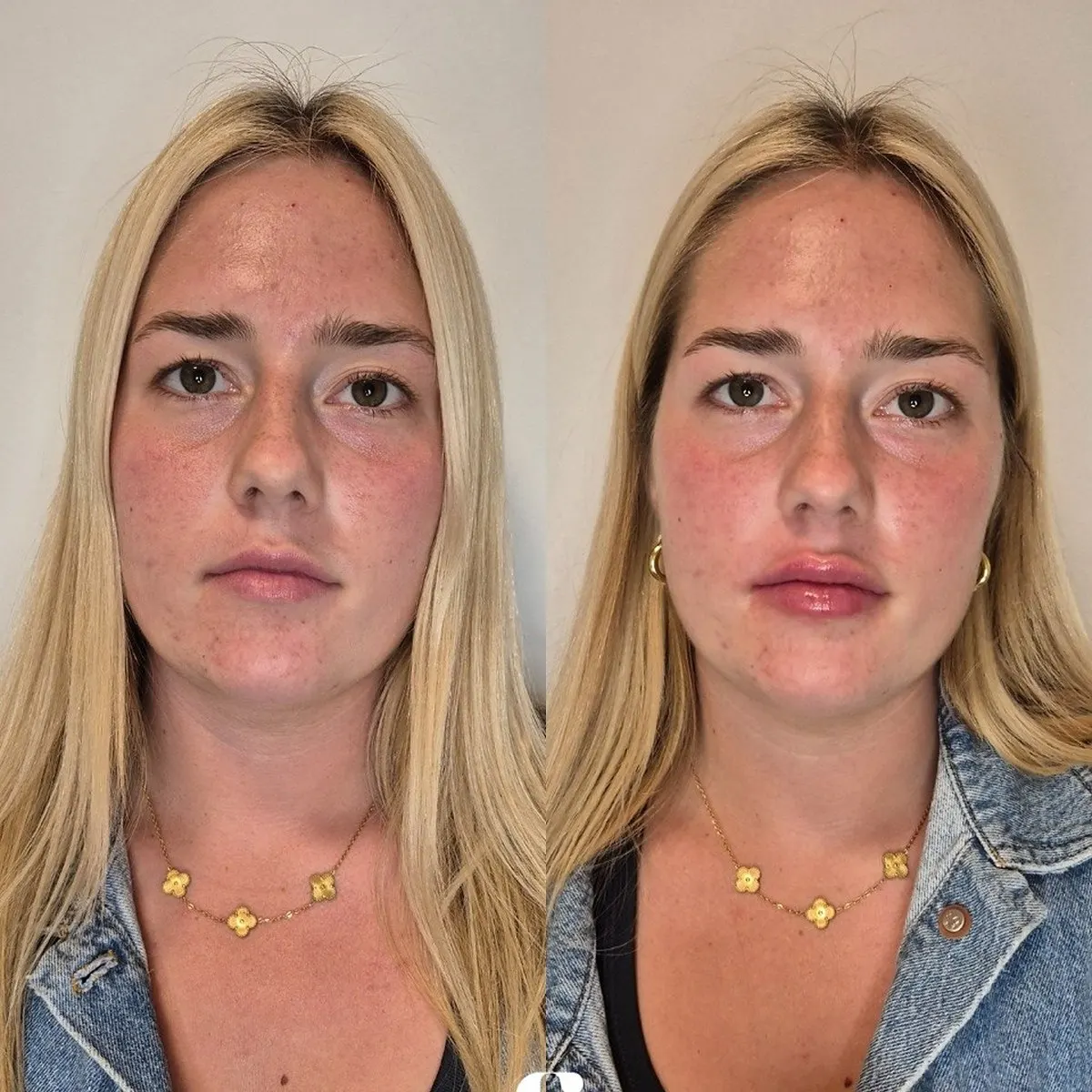 Preenchimento labial · antes e depois