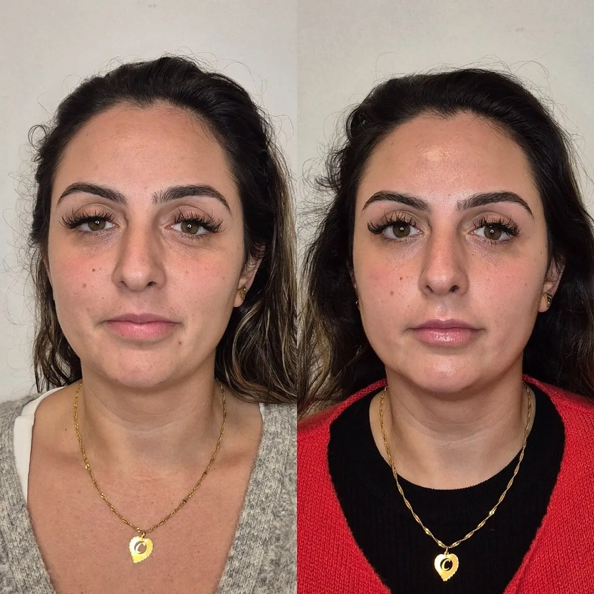 Harmonização facial · antes e depois