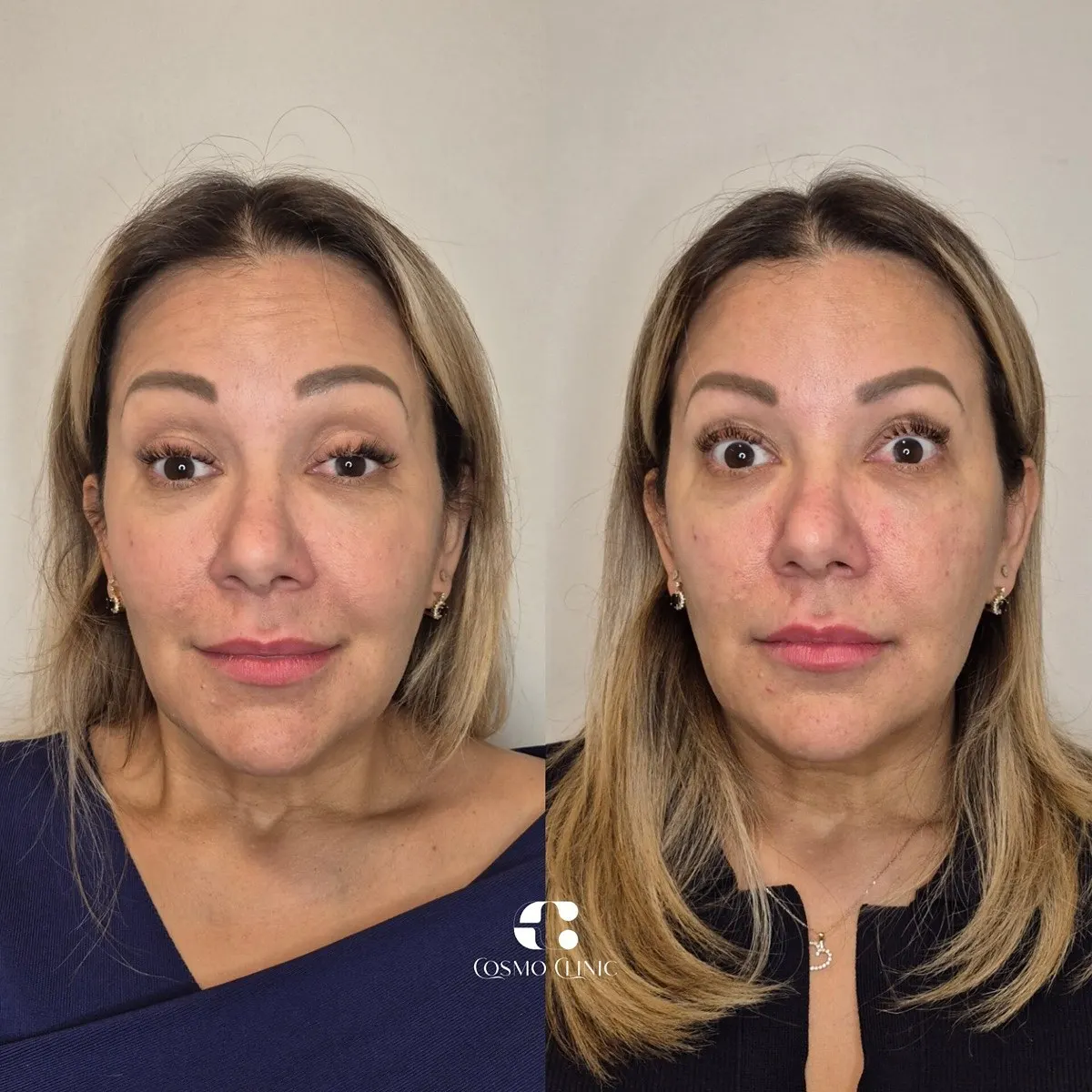 Harmonização facial · antes e depois