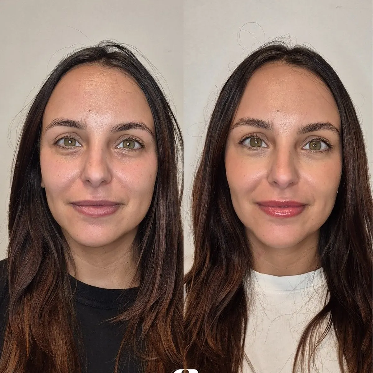 Preenchimento labial · antes e depois