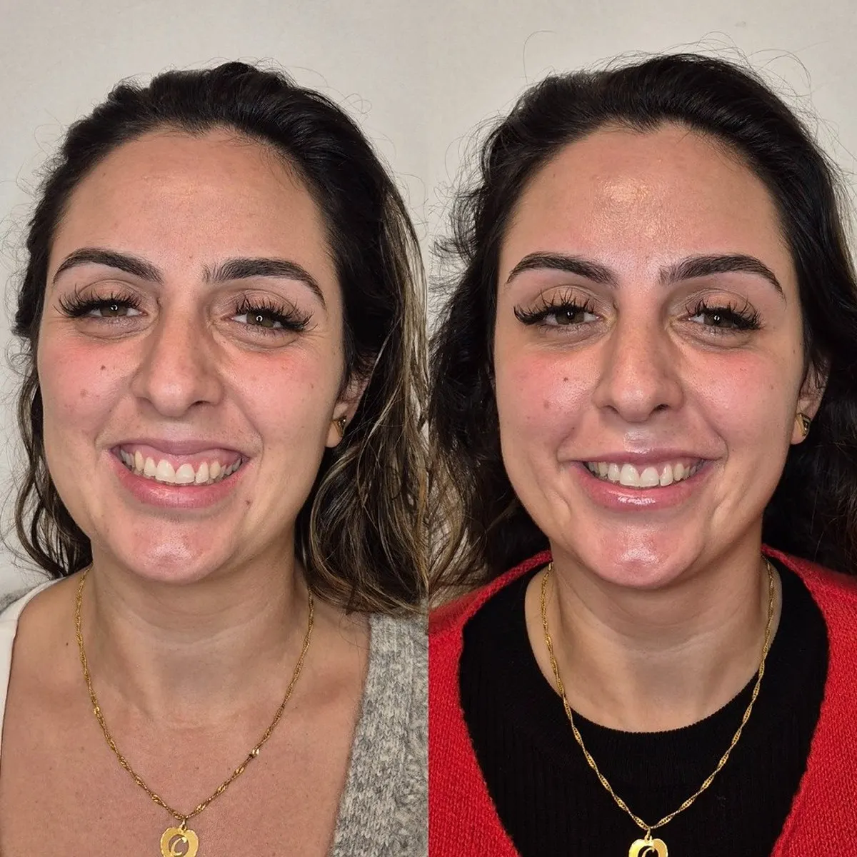Preenchimento labial · antes e depois