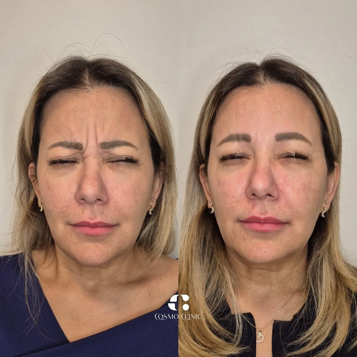 Toxina botulínica · antes e depois