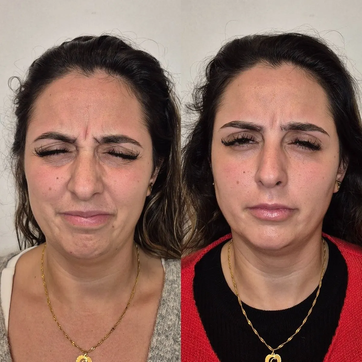 Toxina botulínica · antes e depois