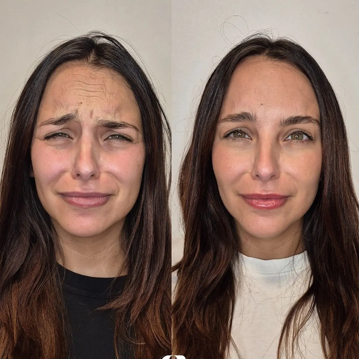 Toxina botulínica · antes e depois