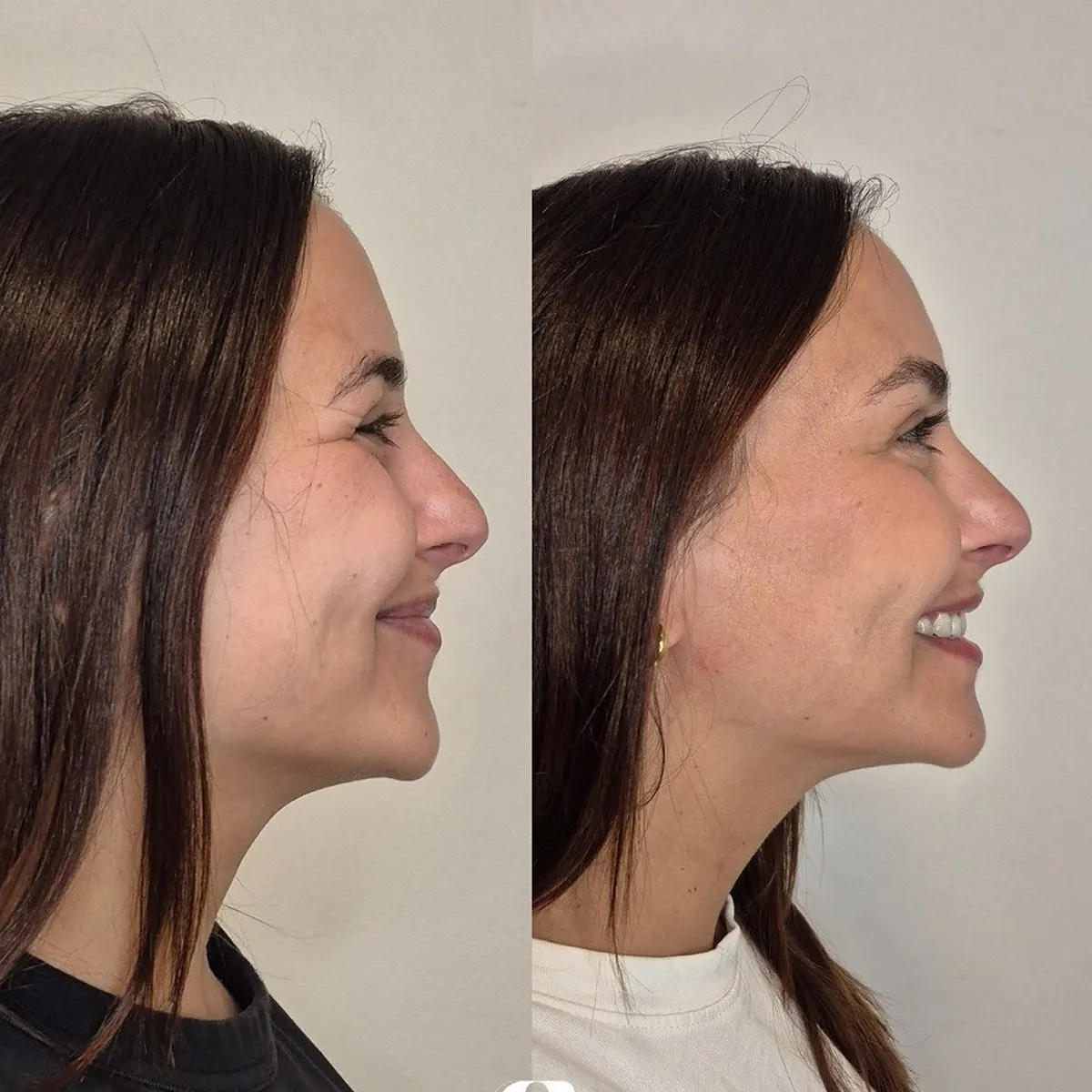 Rinofiller / Preenchimento nasal · antes e depois