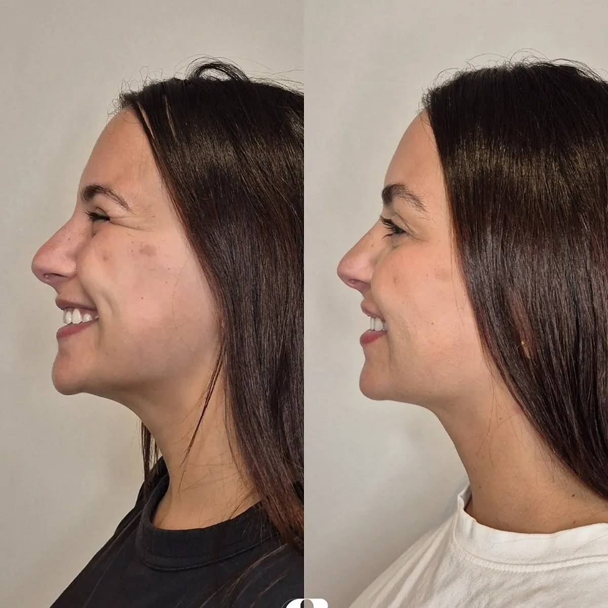 Mento / Contorno mandibular · antes e depois