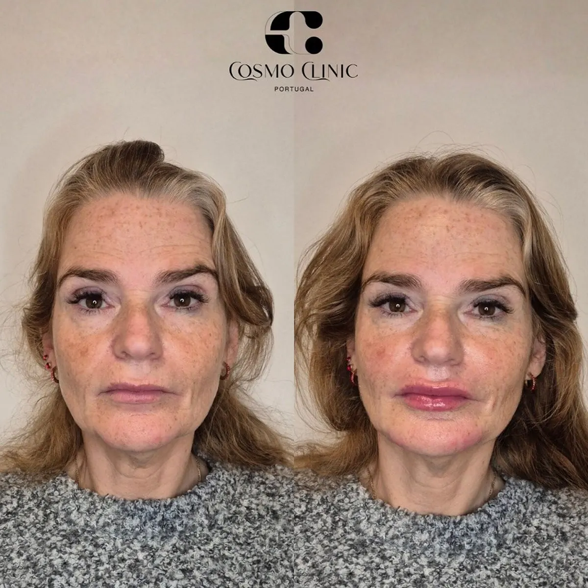 Harmonização facial · antes e depois