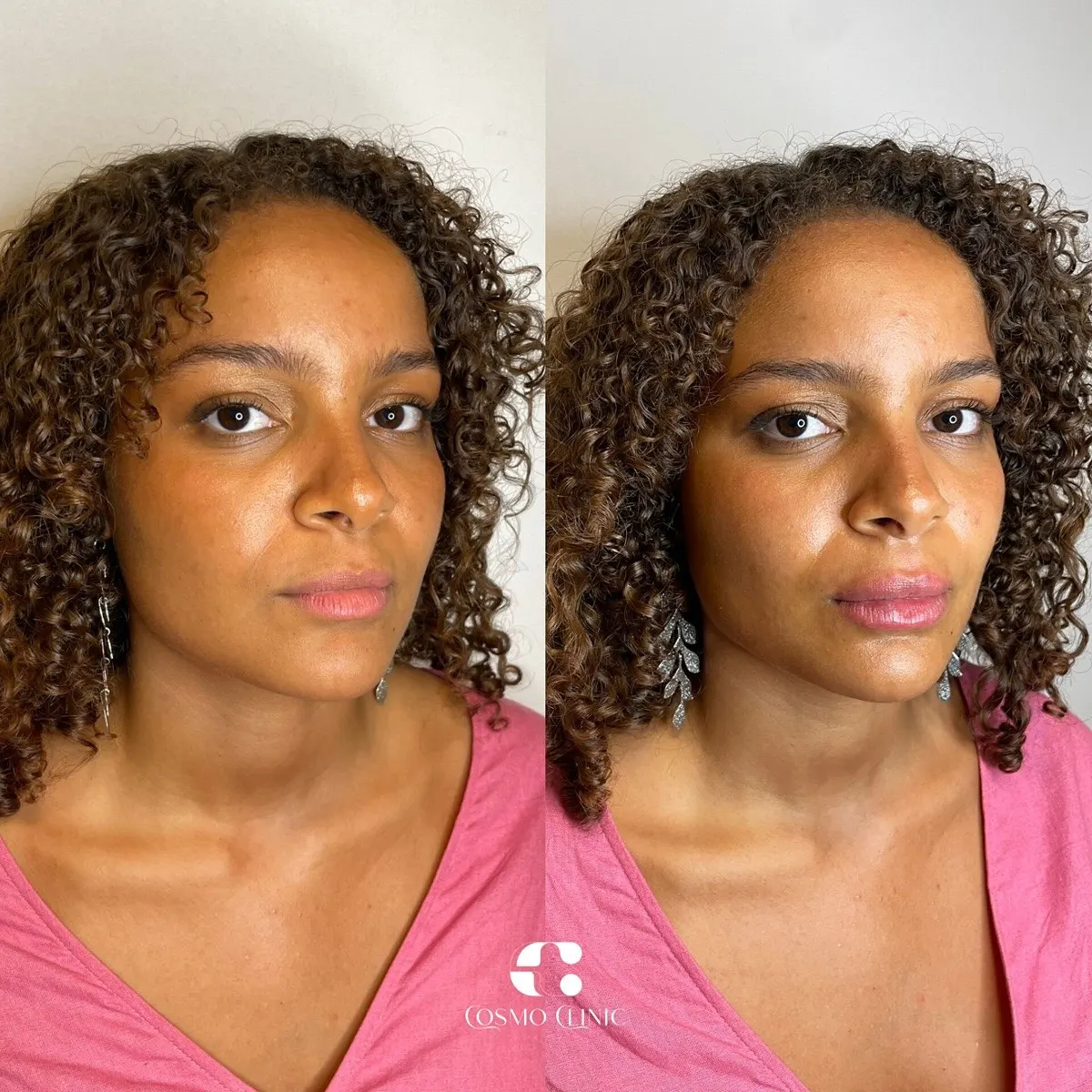 Harmonização facial · antes e depois