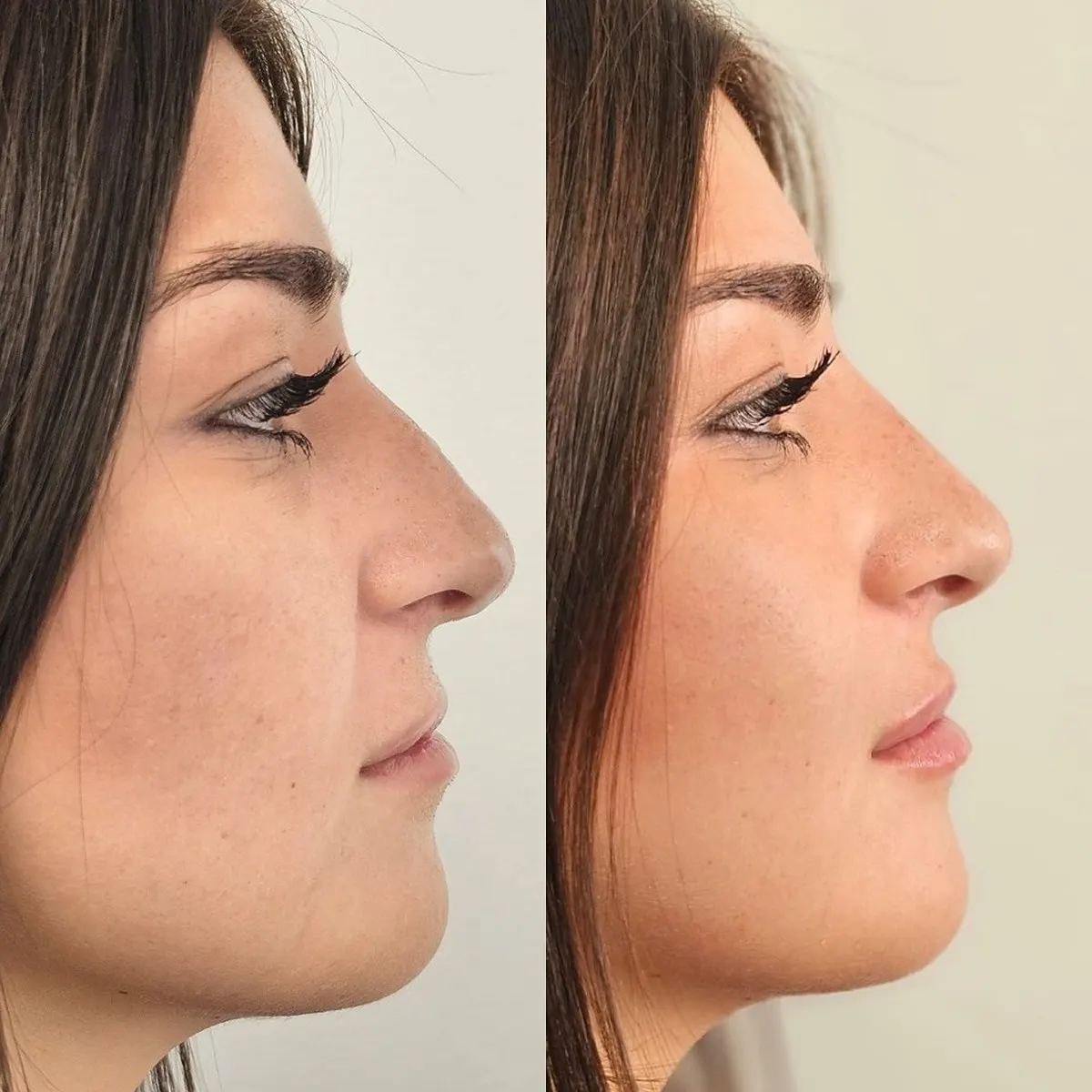 Rinofiller / Preenchimento nasal · antes e depois