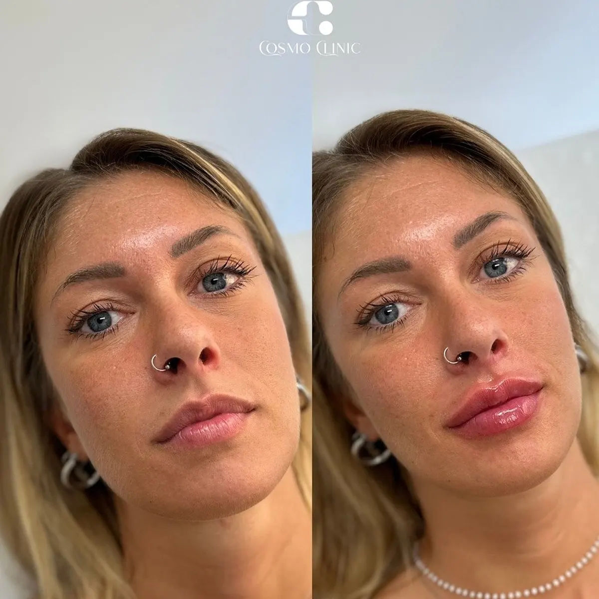 Preenchimento labial · antes e depois