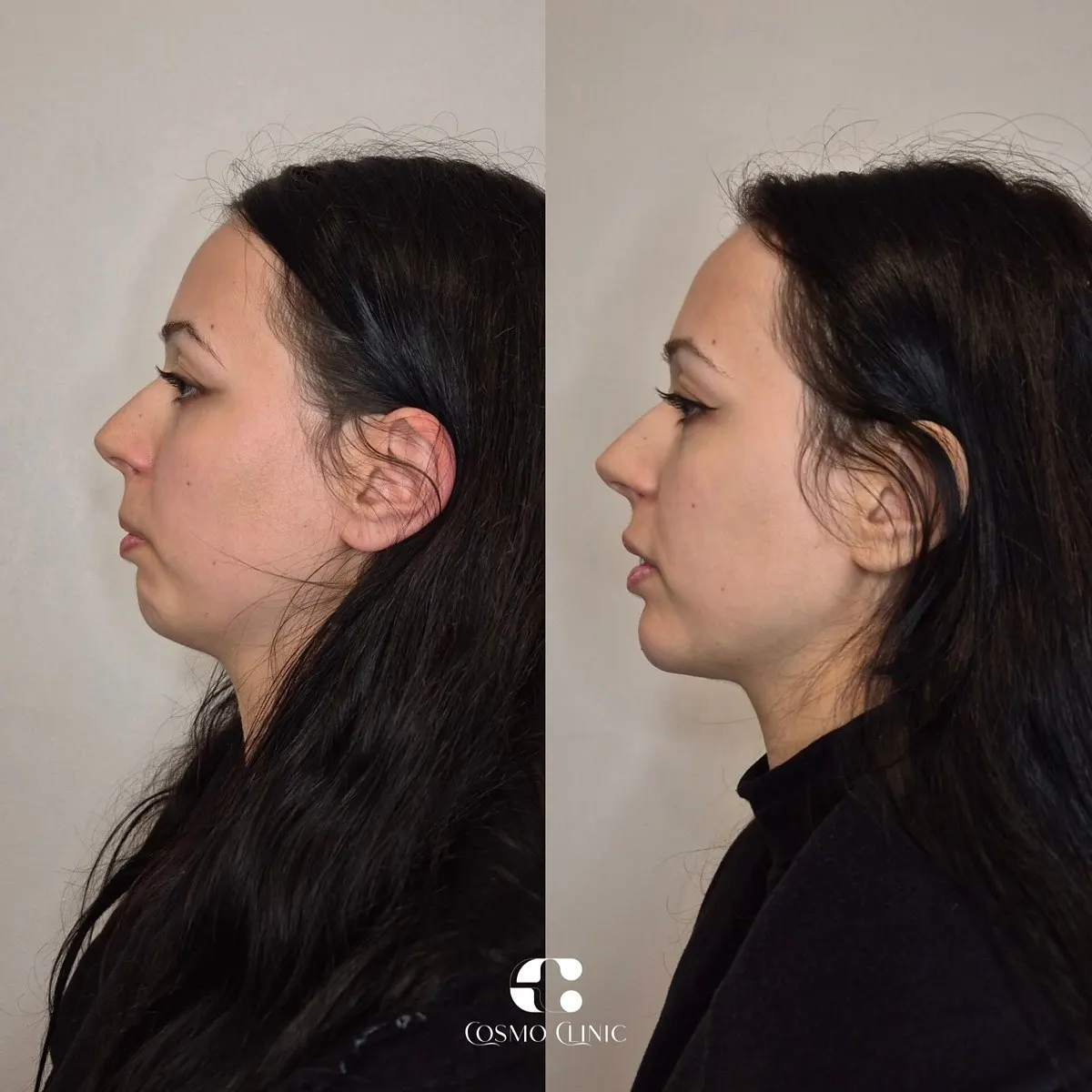 Mento / Contorno mandibular · antes e depois