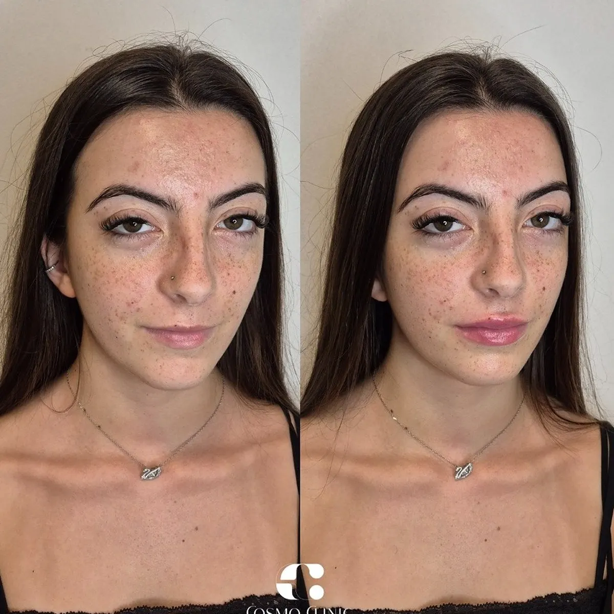 Preenchimento labial · antes e depois