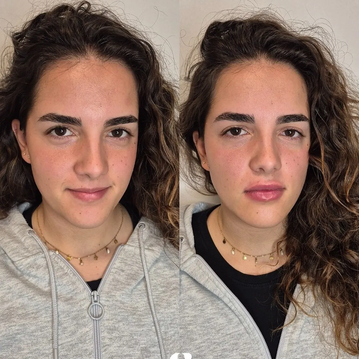 Preenchimento labial · antes e depois