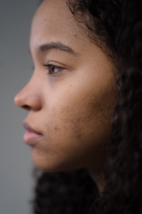 Mulher com expressão facial natural após tratamento de toxina botulínica