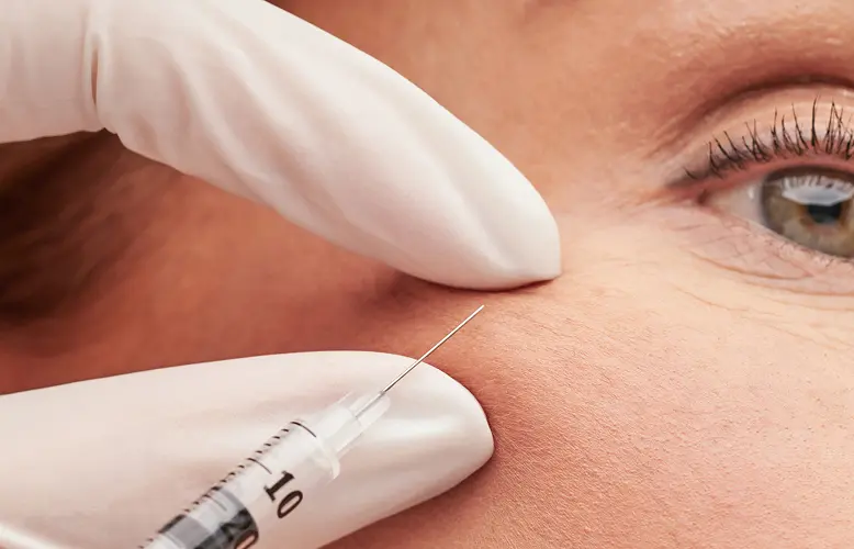 Cheek filler as part of facial harmonization, Cosmo Clinic Lisbon