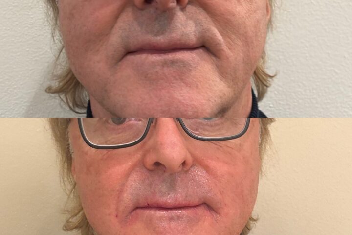 Case 2026-005, Botox, expression lines