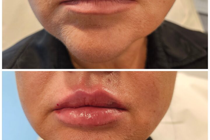 Case 2026-007, Jawline contour