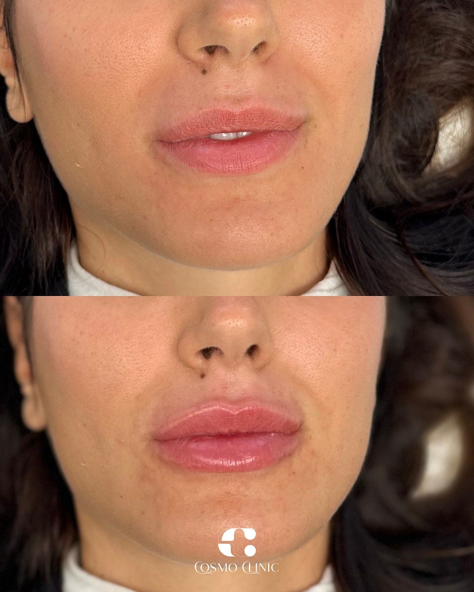 Resultado natural de preenchimento labial