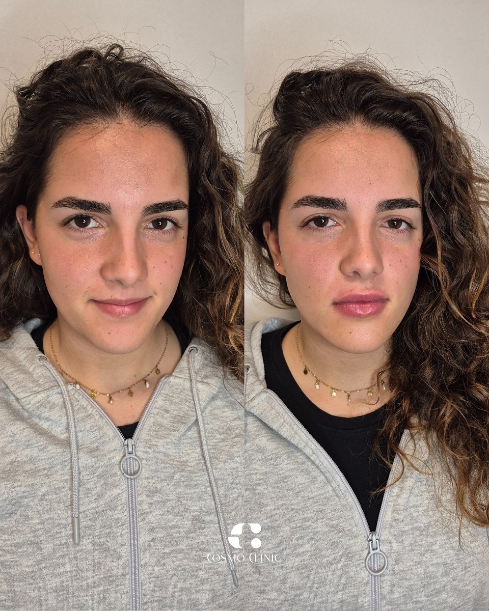 Preenchimento labial antes e depois, Cosmo Clinic Lisboa